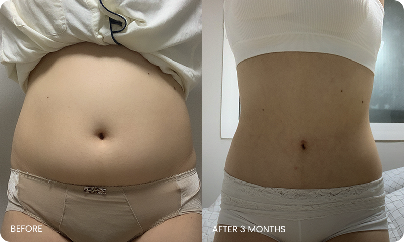 abdominal liposuction bna