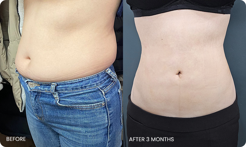 abdominal liposuction bna