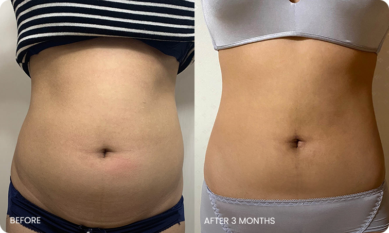 abdominal liposuction bna