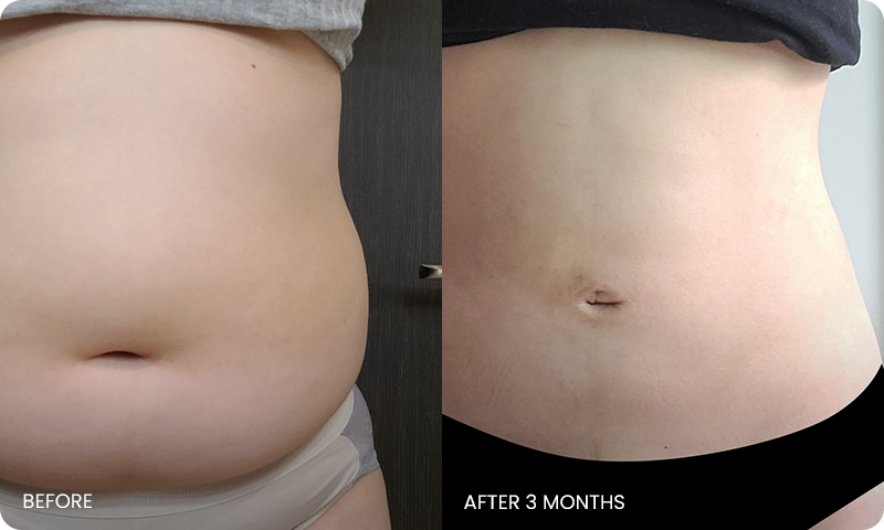 abdominal liposuction bna