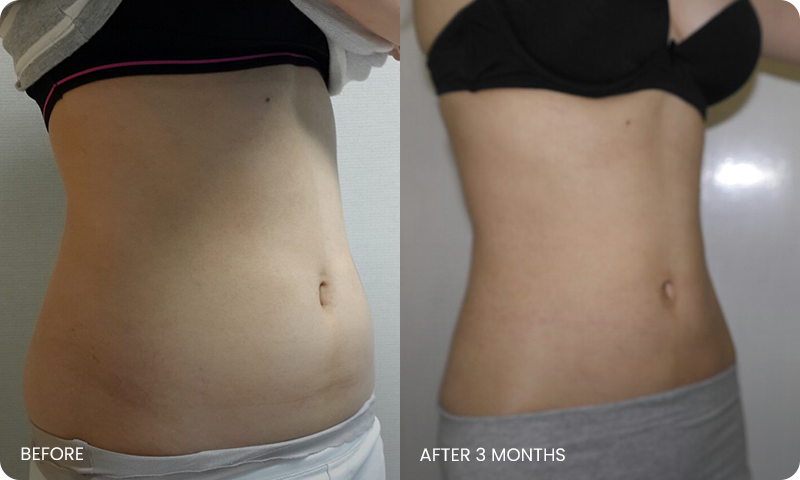 abdominal liposuction bna