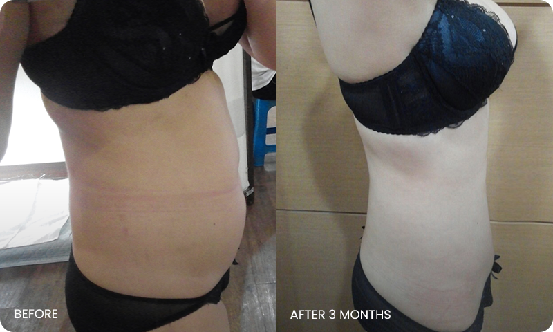 abdominal liposuction bna