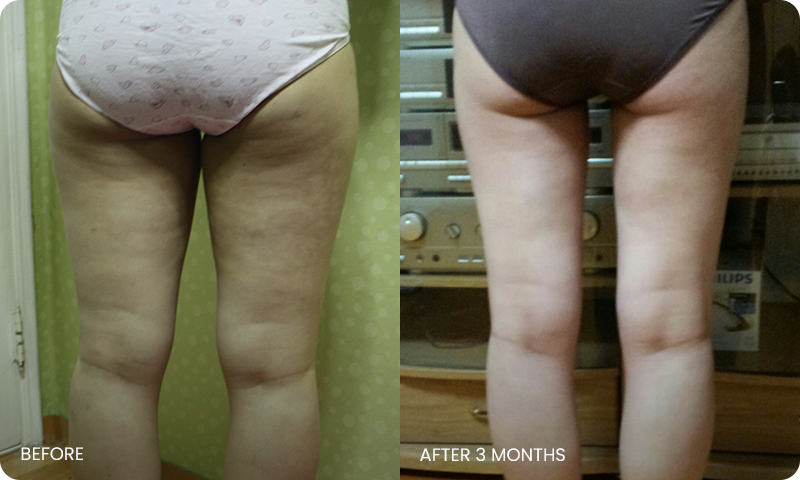 thigh 3D liposuction bna