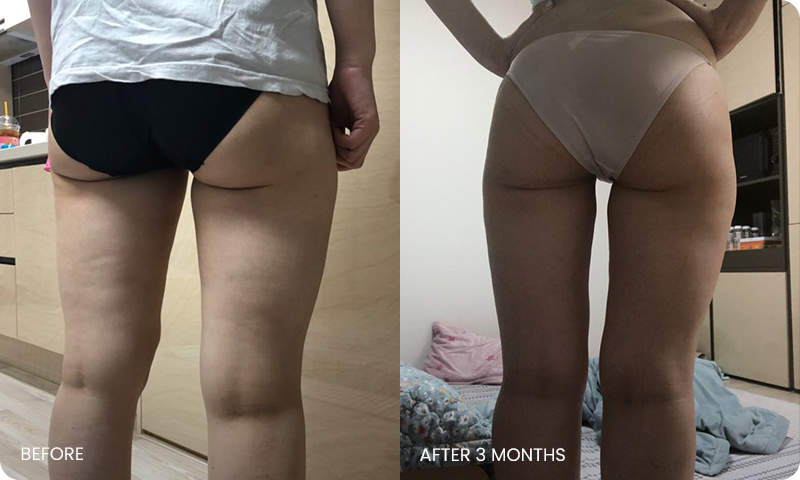 thigh 3D liposuction bna