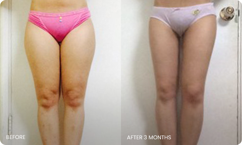 thigh 3D liposuction bna