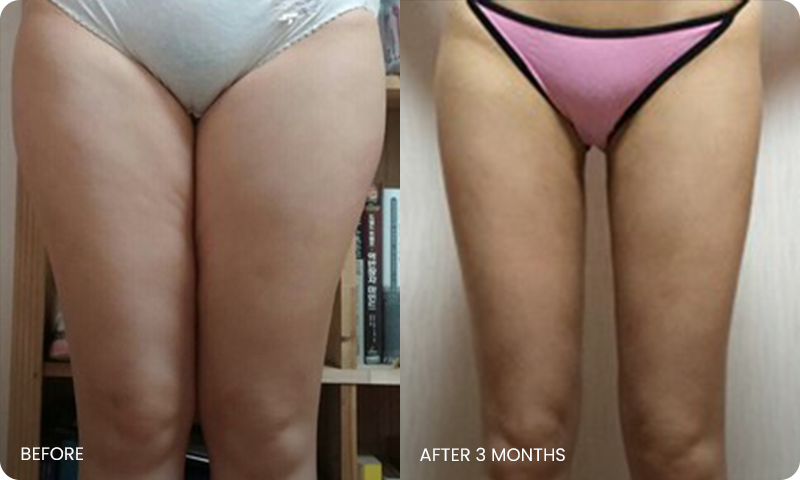 thigh 3D liposuction bna