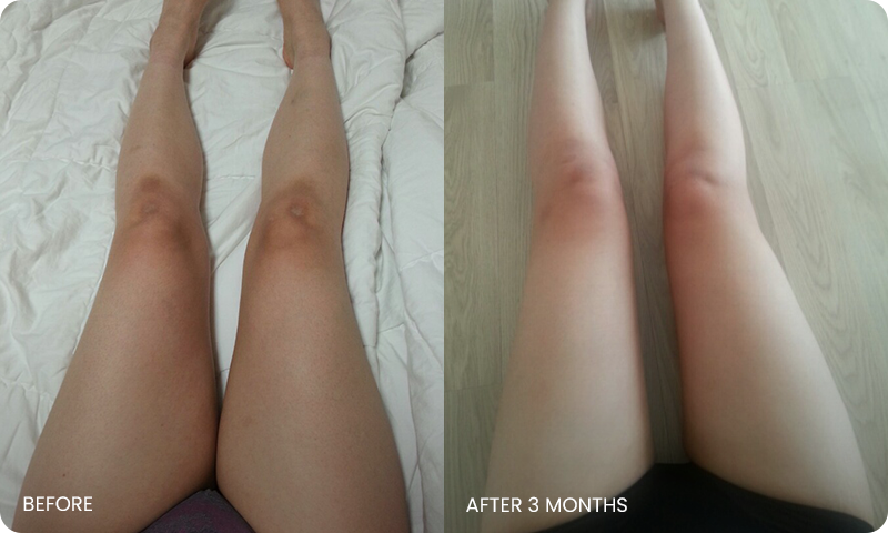 thigh 3D liposuction bna