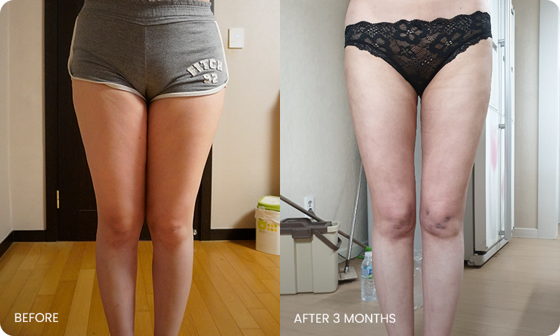 thigh 3D liposuction bna