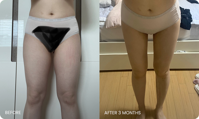 thigh 3D liposuction bna