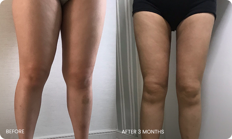 thigh 3D liposuction bna