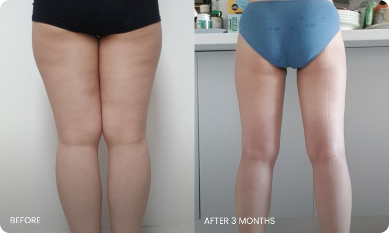 thigh 3D liposuction bna