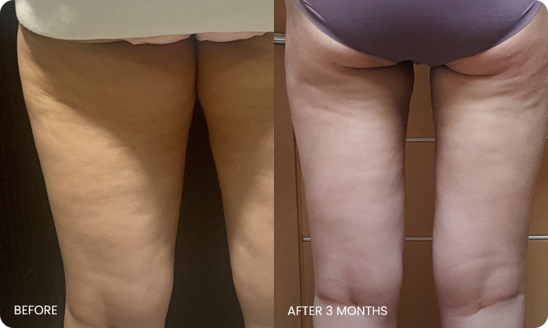 thigh 3D liposuction bna