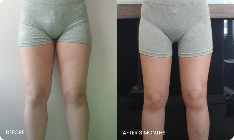 thigh 3D liposuction bna