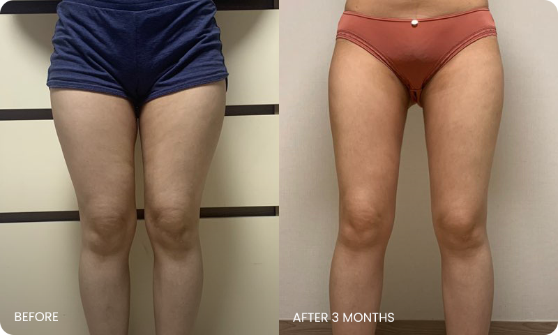 thigh 3D liposuction bna