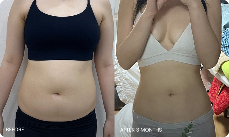 arm and abdominal liposuction liposuction bna