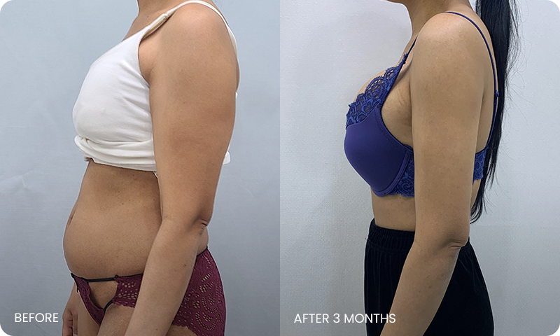 arm and abdominal liposuction liposuction bna