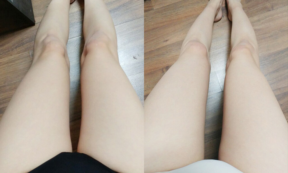 No. 2 treatment site Inner thighs전후사진