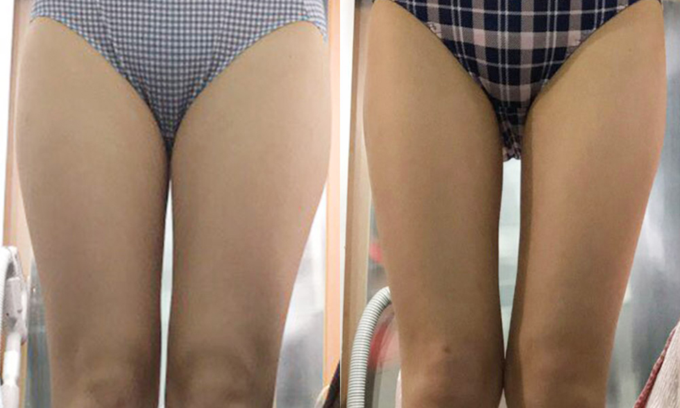 No. 2 treatment site Inner thighs전후사진