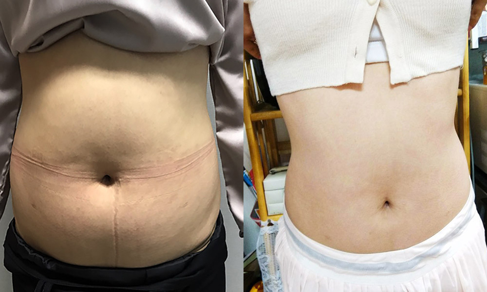 No. 3 treatment site Love handles, upper abdomen, lower abdomen 전후사진