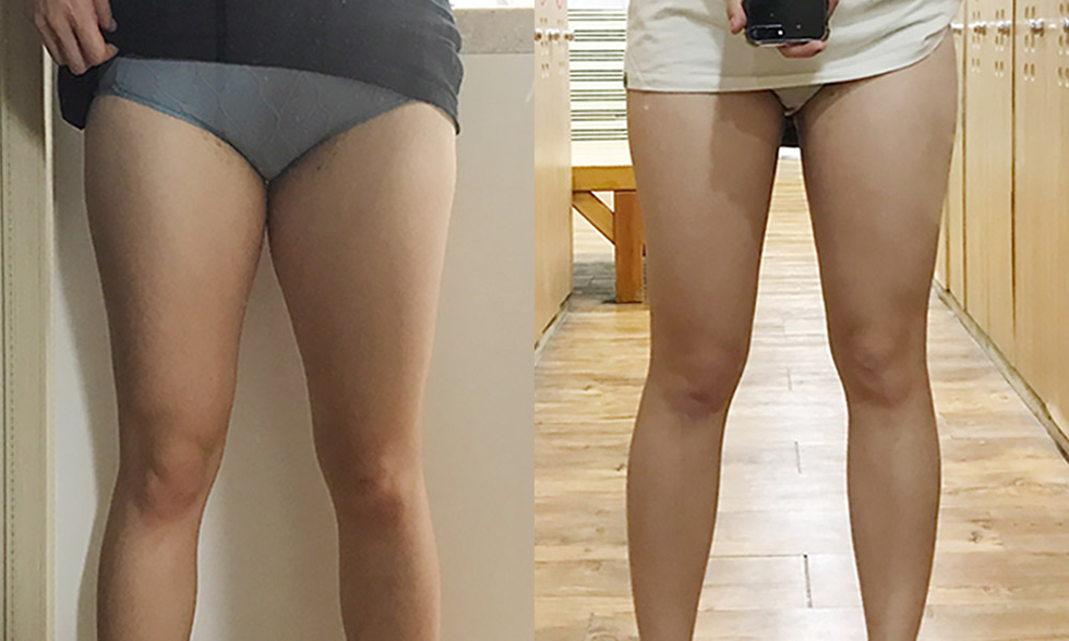 No. 4 treatment site Outer thighs 전후사진