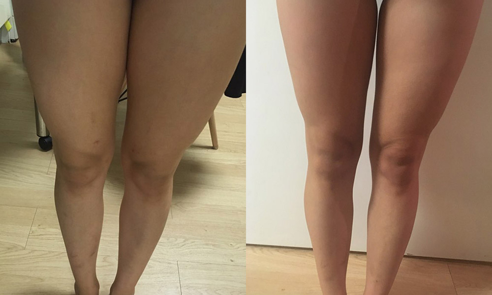 No. 4 treatment site Outer thighs 전후사진