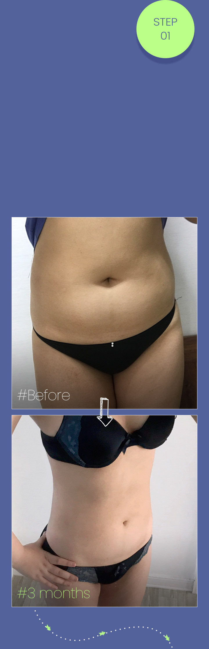 #Large-volume liposuction #Boost your confidence with a smaller waist #Reduce your waist size by more than 3 inches! #Fast recovery and immediate results!