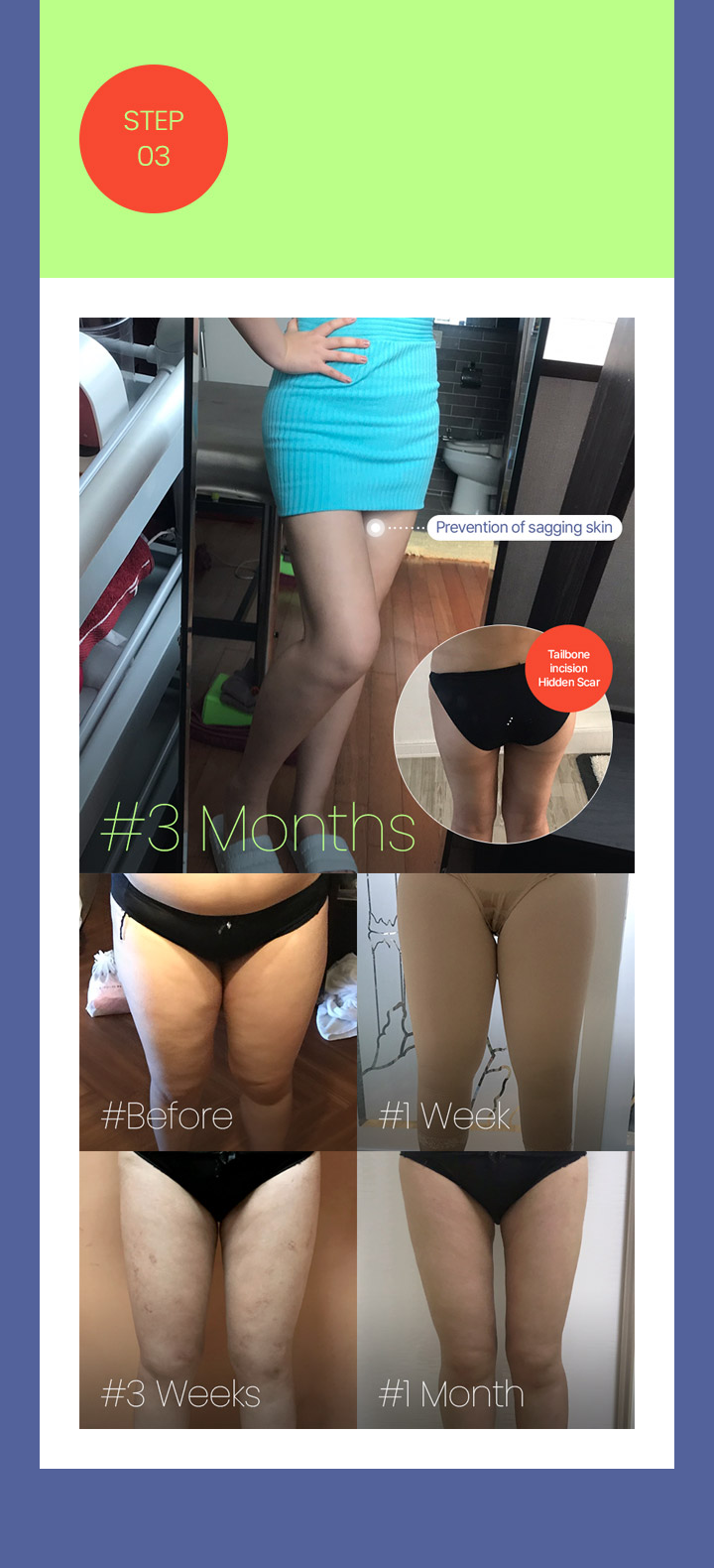 7,000cc fat extraction from the thighs, buttocks, and knees for a complete full-body liposuction! Fat removal from the thighs, where there is most fat, yields the most visible results! Considerations for thigh liposuction: skin sagging, fat removal around the knees, and hidden scars