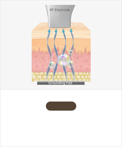 STEP 01 Delivers 6.78 MHz RF current to the dermis