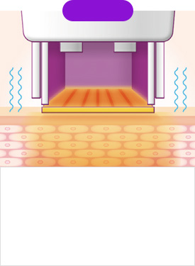 STEP 03 The heat produced by the RF energy penetrates deep into the dermis and pain is reduced with continuous vibration