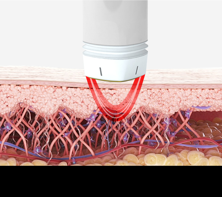 Bipolar RF