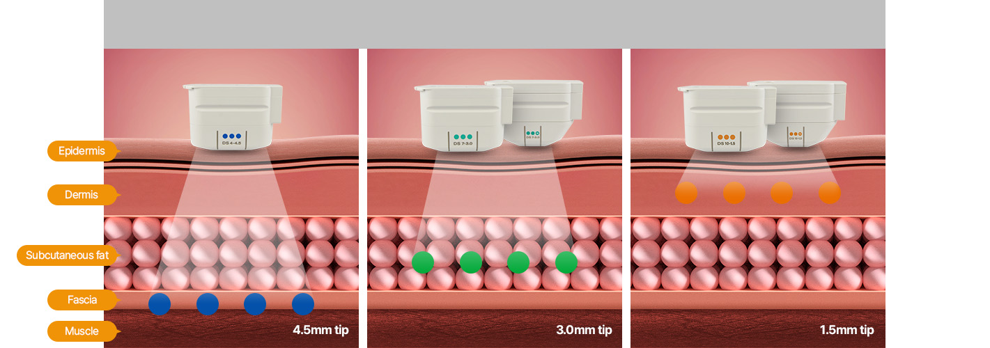 Where energy is generated by tip type