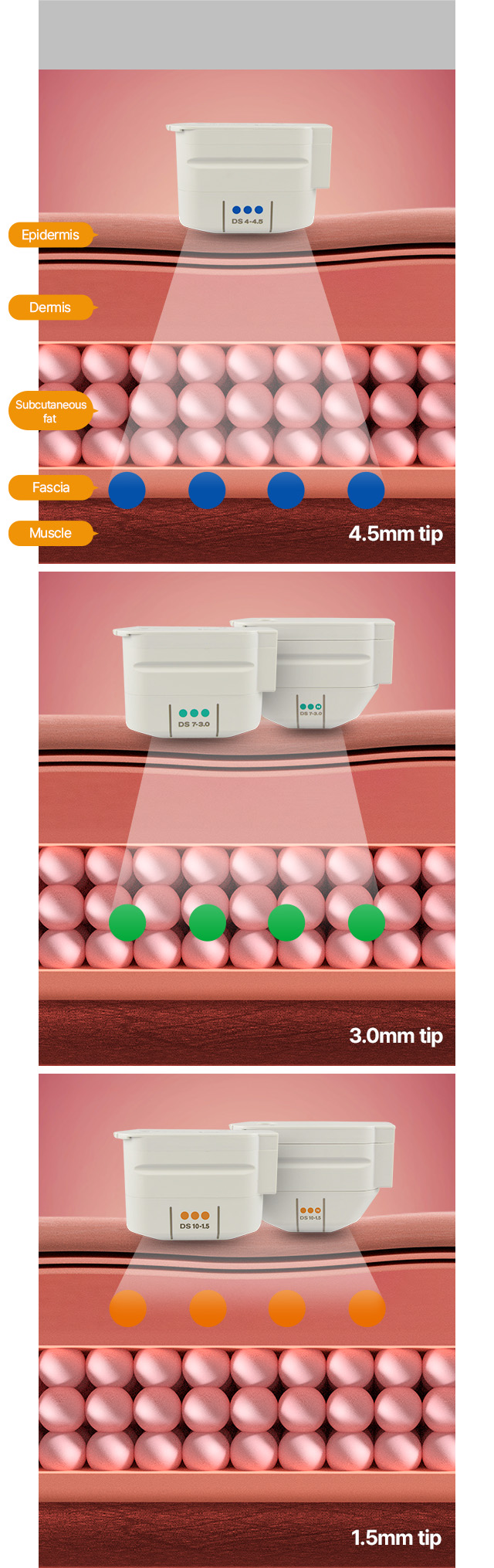 Where energy is generated by tip type