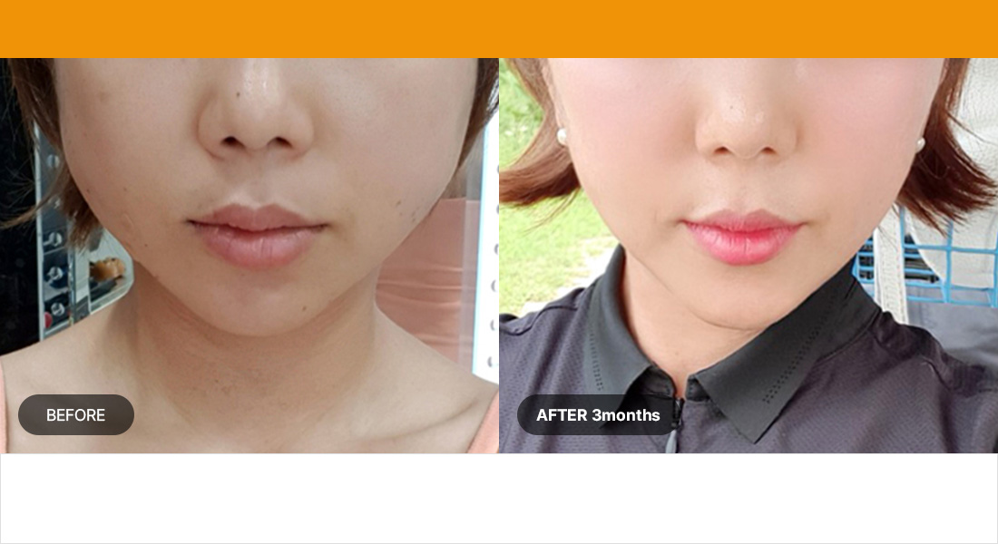 Number of shots : 300shots / Age group : 20s to early 30s Improves the appearance of nasolabial folds and sagging jawline, shrinks pores, and prevents sunken cheeks 1.5mm regular 100shots + 4.5mm 200shots