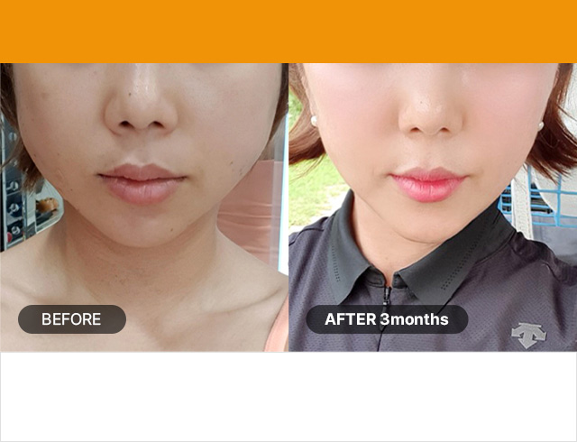 Number of shots : 300shots / Age group : 20s to early 30s Improves the appearance of nasolabial folds and sagging jawline, shrinks pores, and prevents sunken cheeks 1.5mm regular 100shots + 4.5mm 200shots