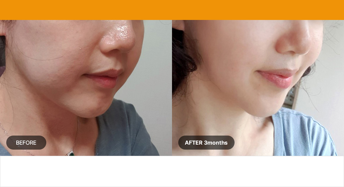 Number of shots : 500shots / Age group : Mid-30s to Late 40s Improves drooping eyelids, under-eye wrinkles, sagging jawline, and nasolabial folds, and shrinks pores 1.5mm narrow/regular 50shots/100shots + 3.0mm 150shots + 4.5mm 200shots