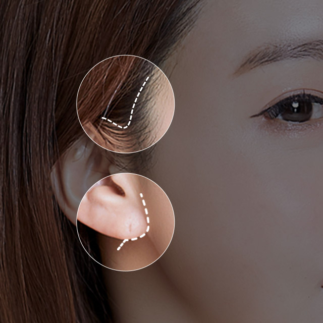 Minimal incision along the earlobe or hairline