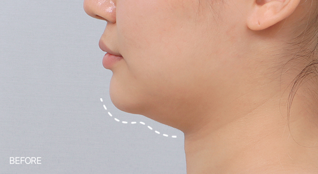 The double chin reduction procedure performed at Say Yes involves not just the removal of subcutaneous fat (double chin liposuction + double chin muscle tying), but the tying of the muscles. This helps restore the reduced skin elasticity and create a beautiful jawline, which could not be achieved with diet or surgery alone.