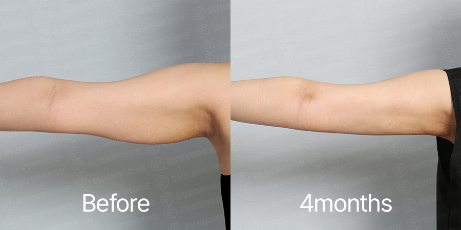 Arm360 b&a photo