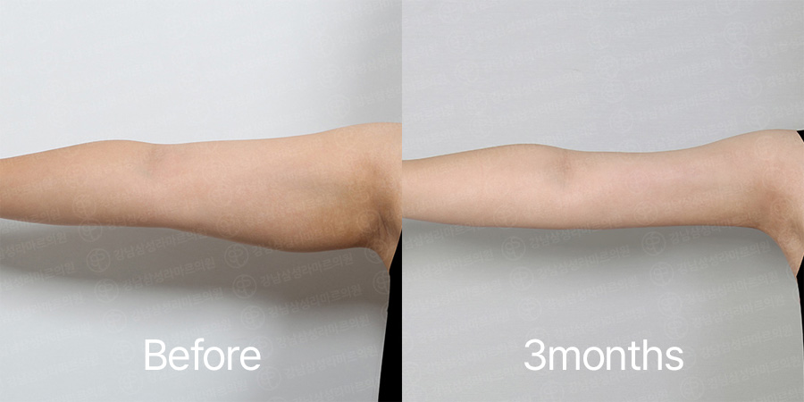 Arm360 b&a photo