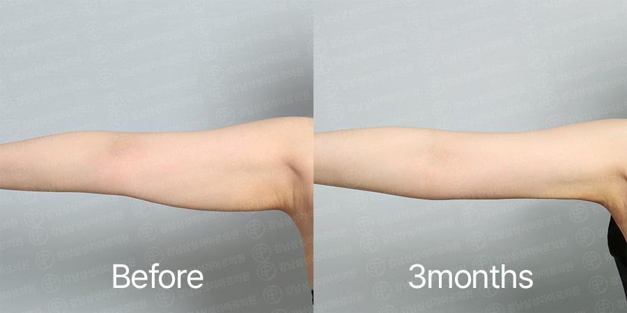 Arm360 b&a photo