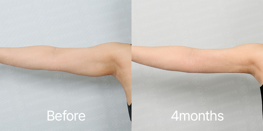 Arm360 b&a photo