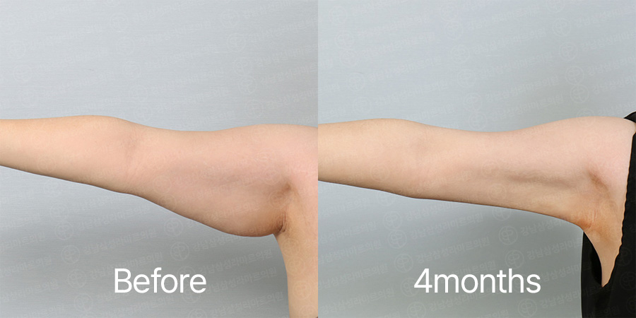 Arm360 b&a photo