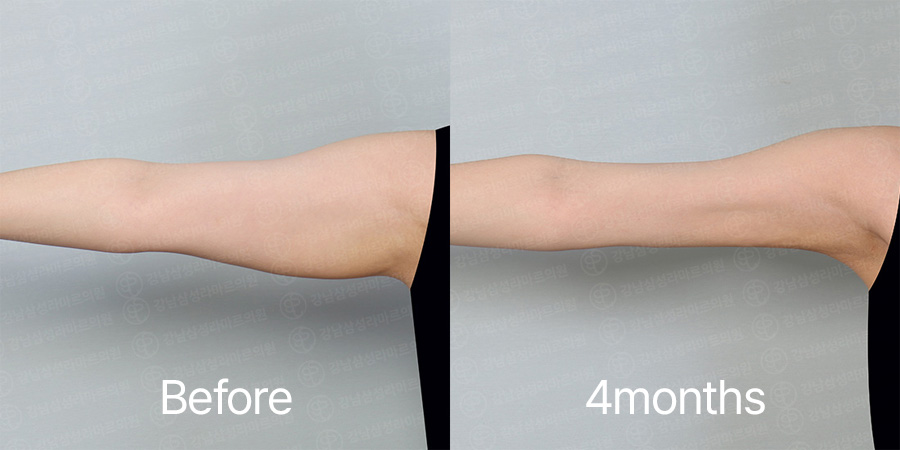 Arm360 b&a photo