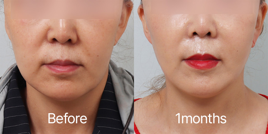 Facelift b&a photo