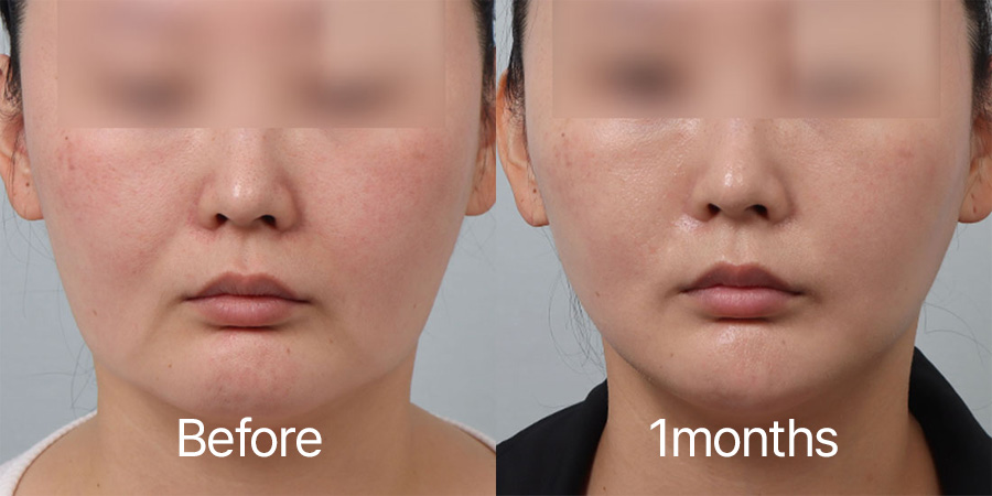 Facelift b&a photo