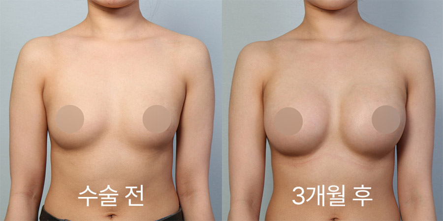 Breast Surgery b&a photo