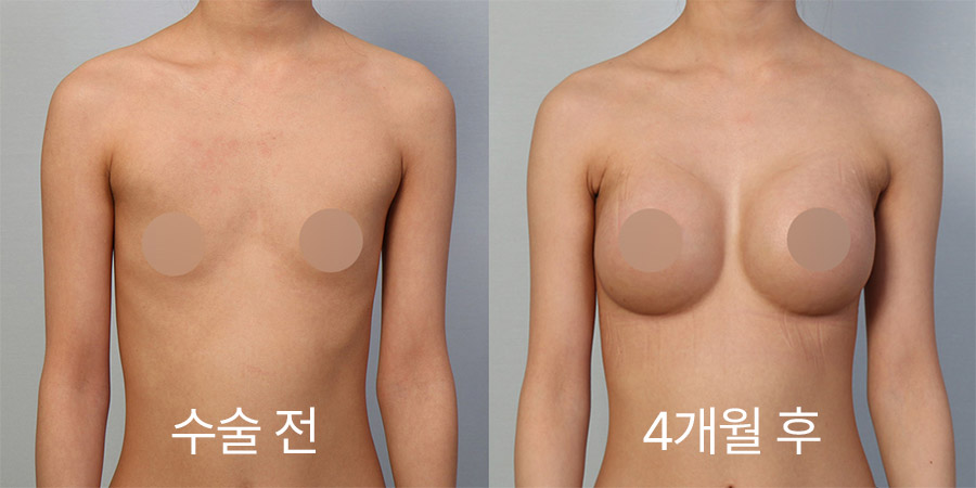 Breast Surgery b&a photo