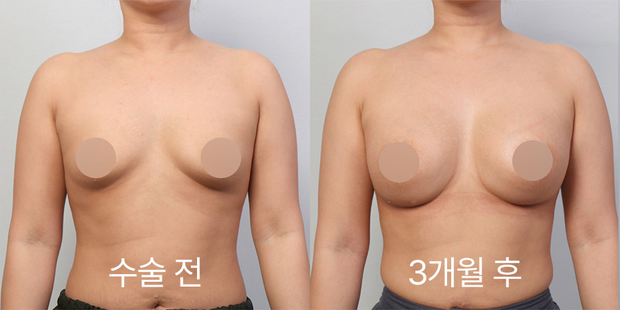 Breast Surgery b&a photo