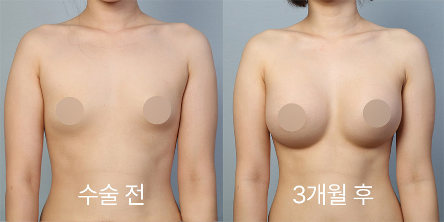 Breast Surgery b&a photo