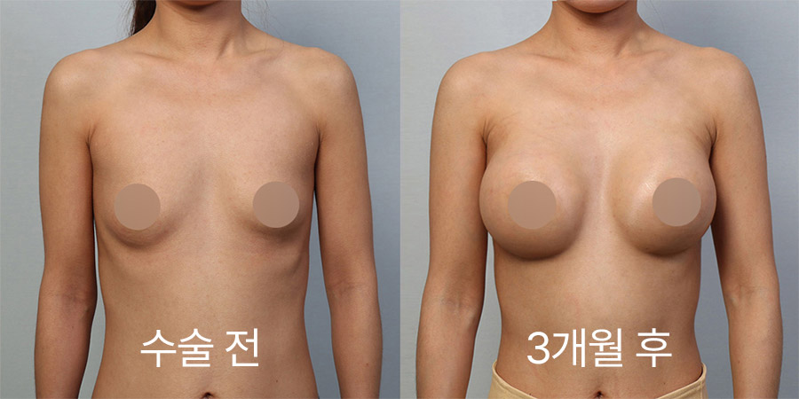 Breast Surgery b&a photo